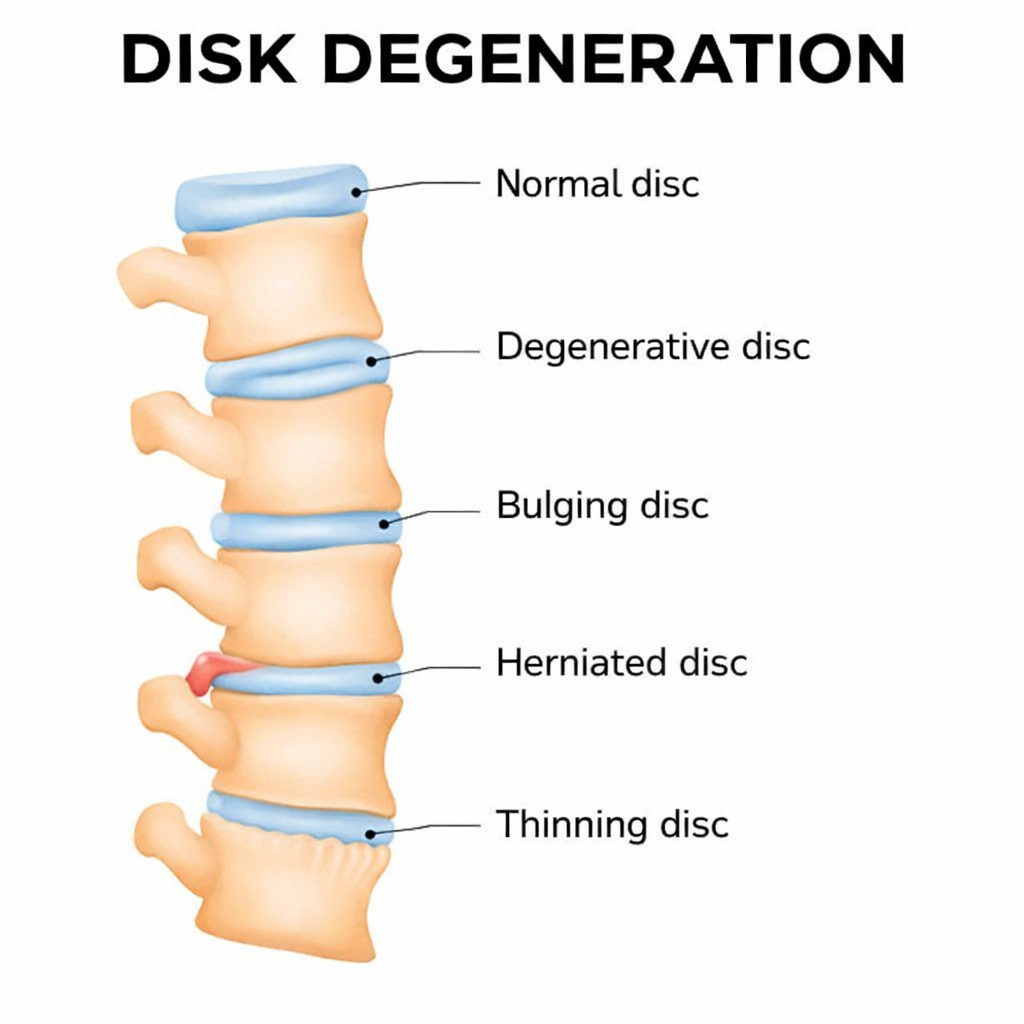 Degenerative disc disease diagram showing disc height loss and degeneration