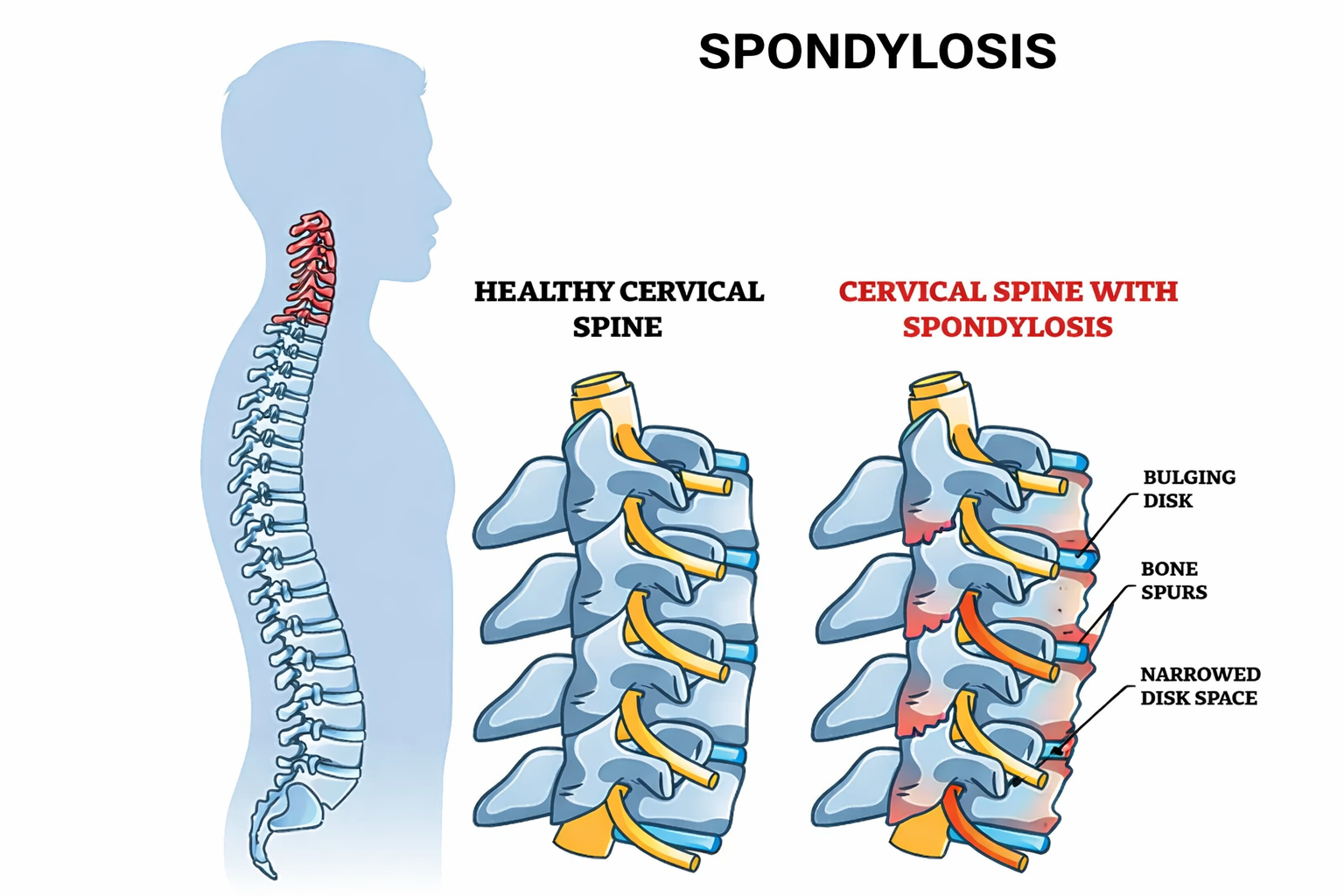 Spinal arthritis spondylosis diagram showing bone spurs and degenerative changes