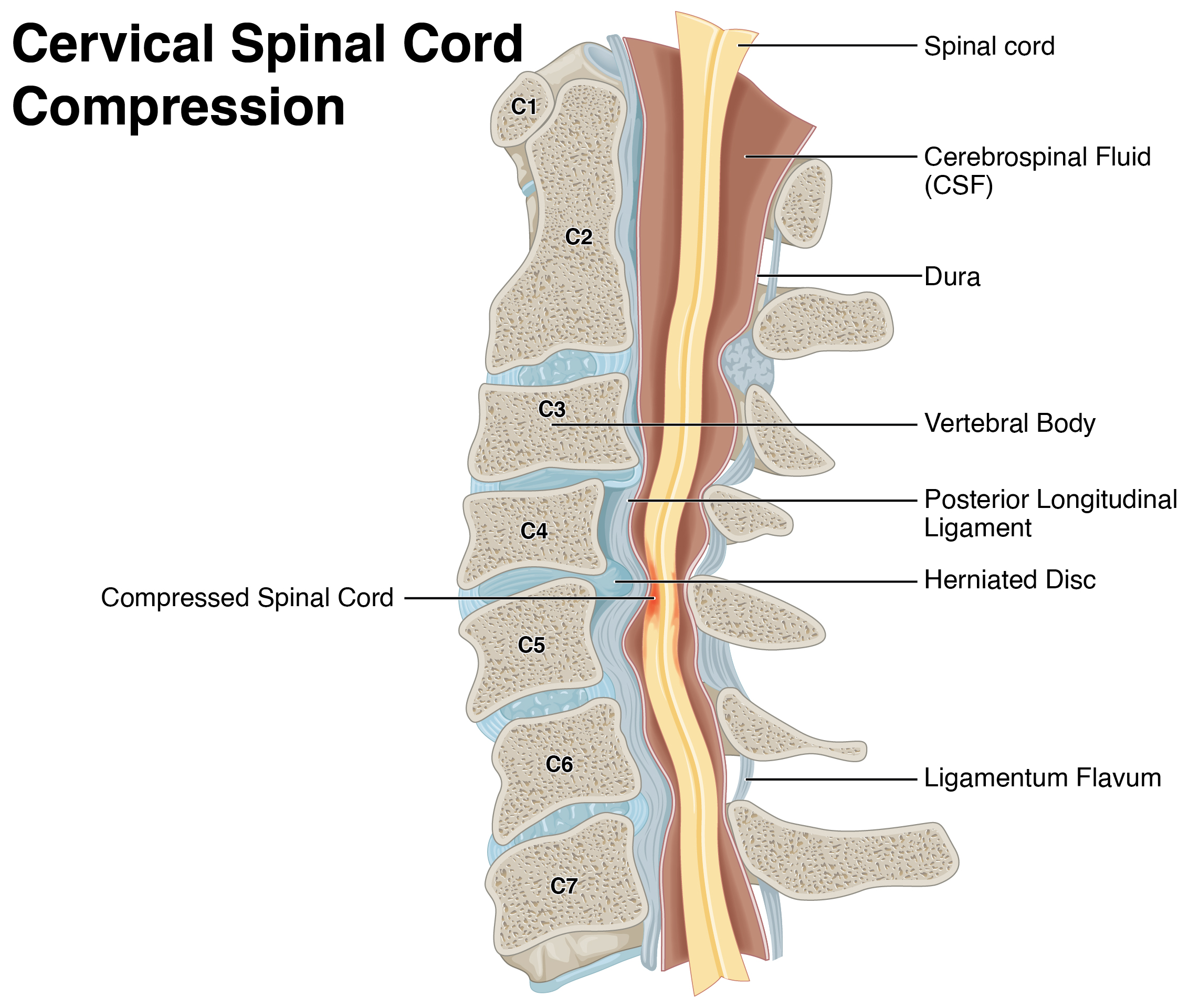 Spinal cord compression diagram showing pressure on the spinal cord