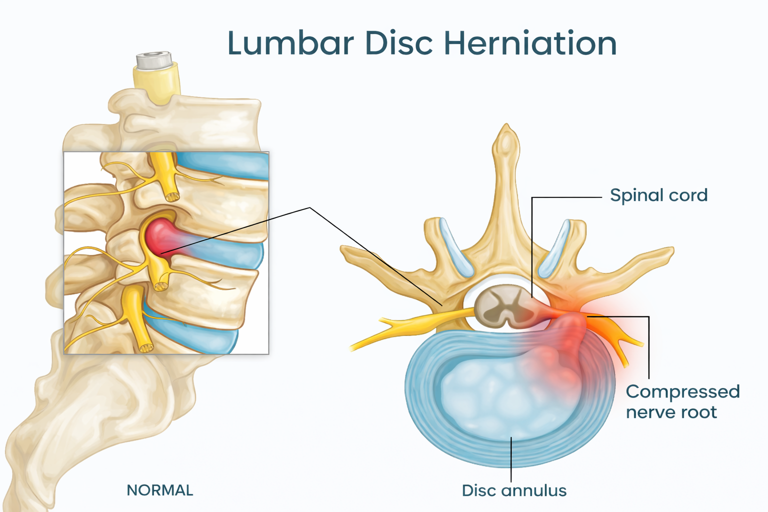 Lumbar disc herniation compressing spinal nerve diagram