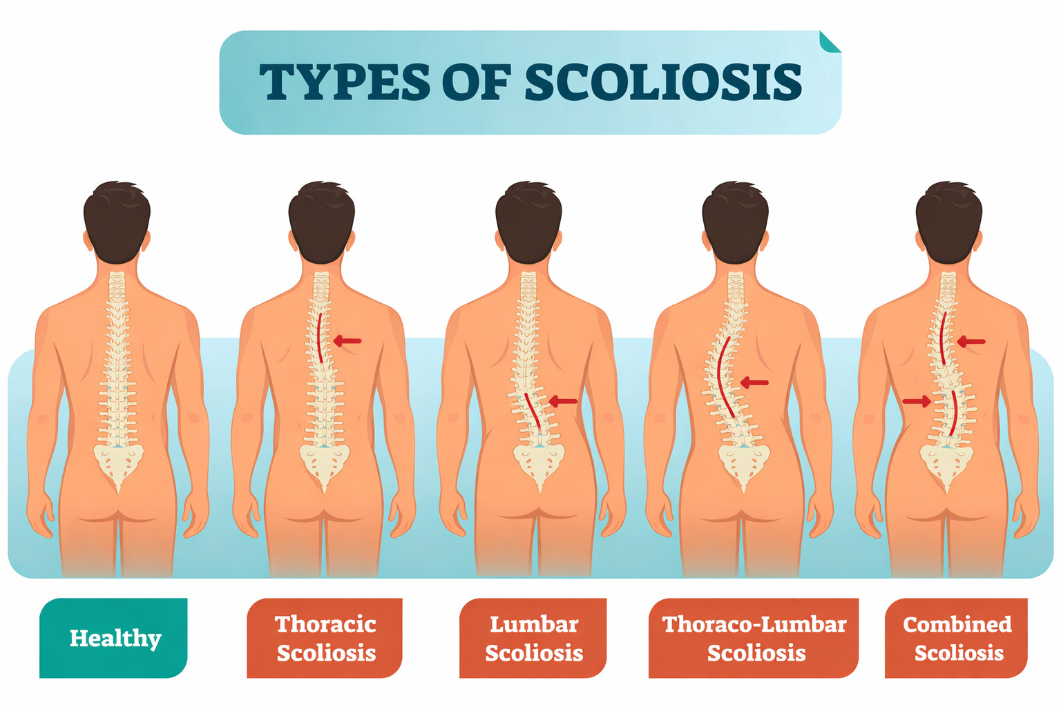 Scoliosis spinal deformity curvature diagram