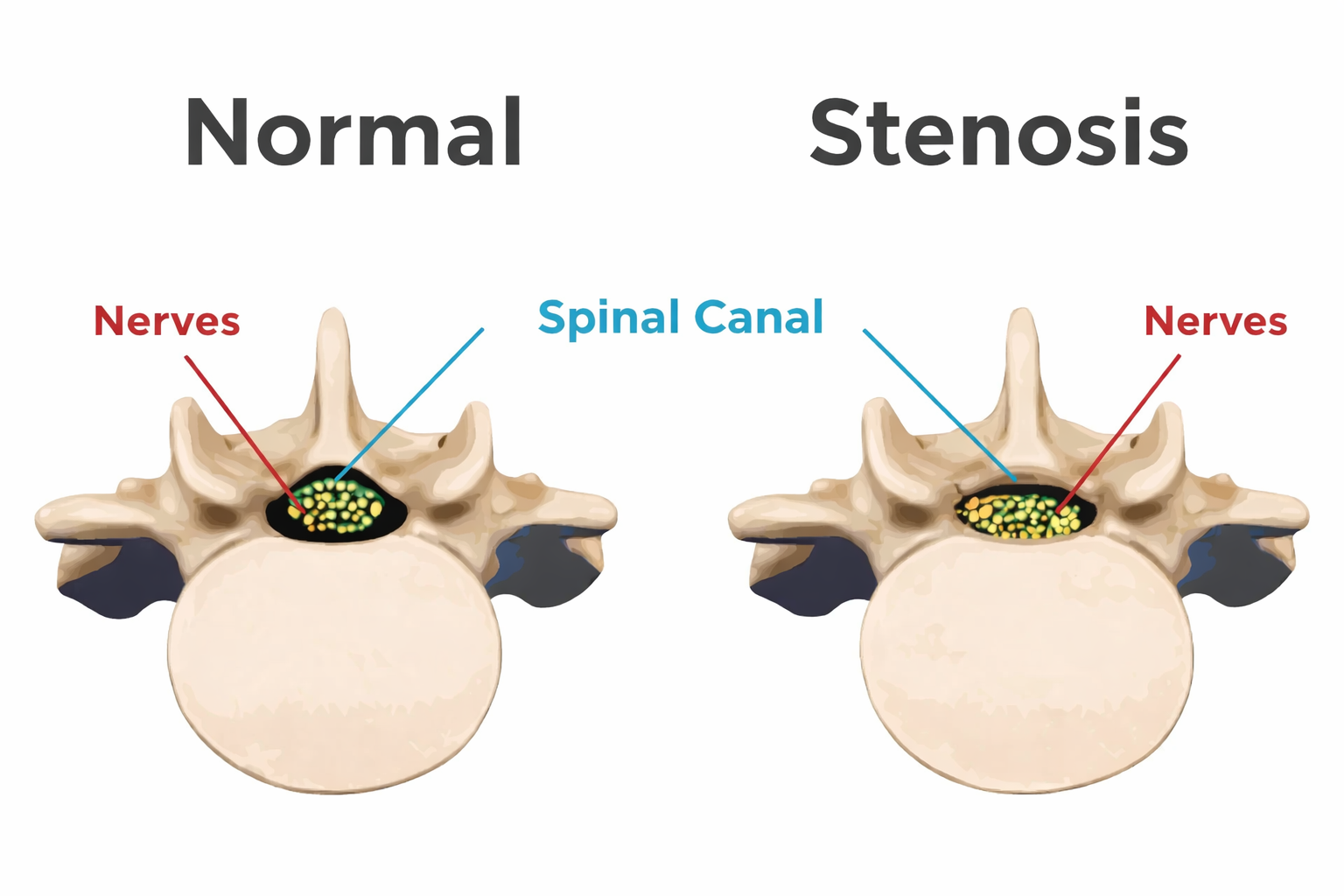 Lumbar spinal stenosis narrowing of the spinal canal diagram